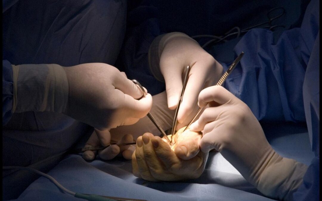 Protesi 3D sul polso di una giovane paziente: importante intervento del Dott. Cannavò