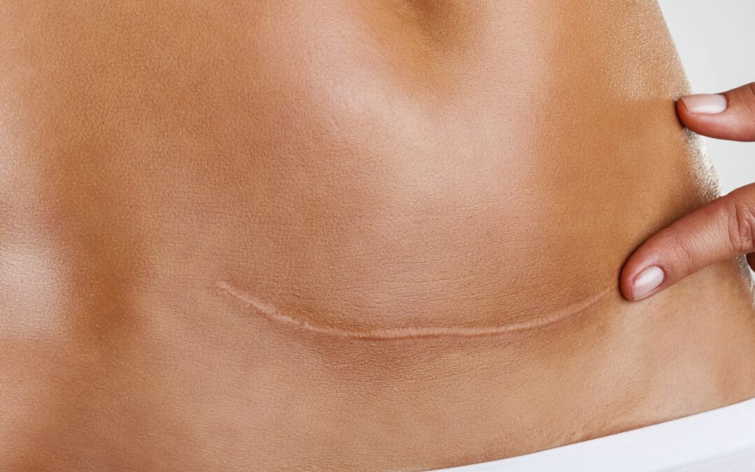 Cicatrici: prevenzione e trattamento